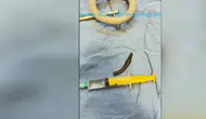 Hastanın boğazından ameliyatla canlı sülük çıkarıldı