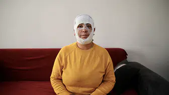 Cilt bakımı sonrası yüzünde yanık oluşan kadın şikayetçi oldu