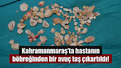 Kahramanmaraş’ta hastanın böbreğinden bir avuç taş çıkartıldı!