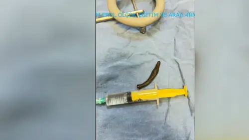 Hastanın boğazından ameliyatla canlı sülük çıkarıldı